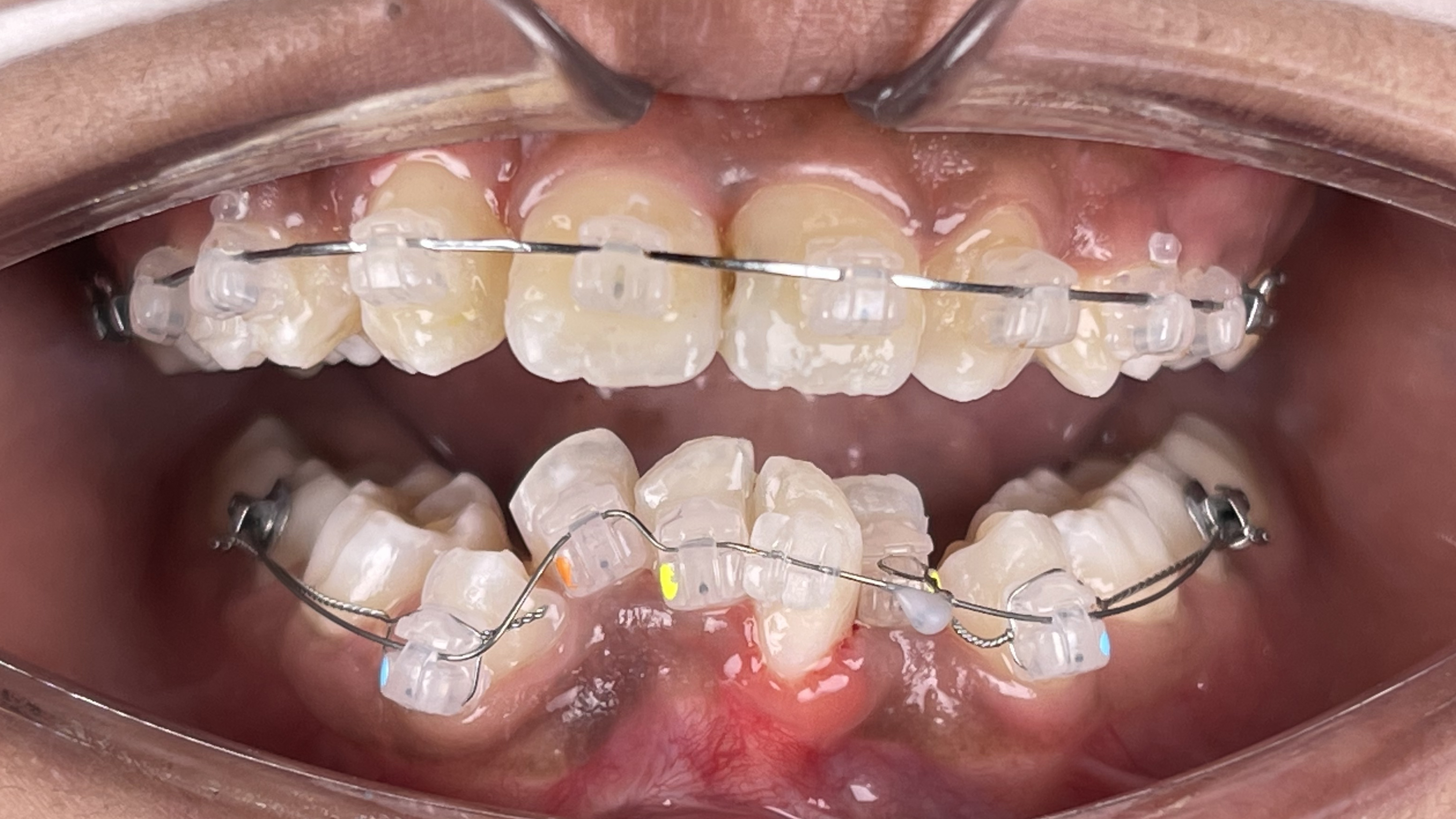 Narrow jaw correction